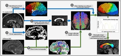 Mapping corpus callosum surface reduction in fetal alcohol spectrum disorders with sulci and connectivity-based parcellation